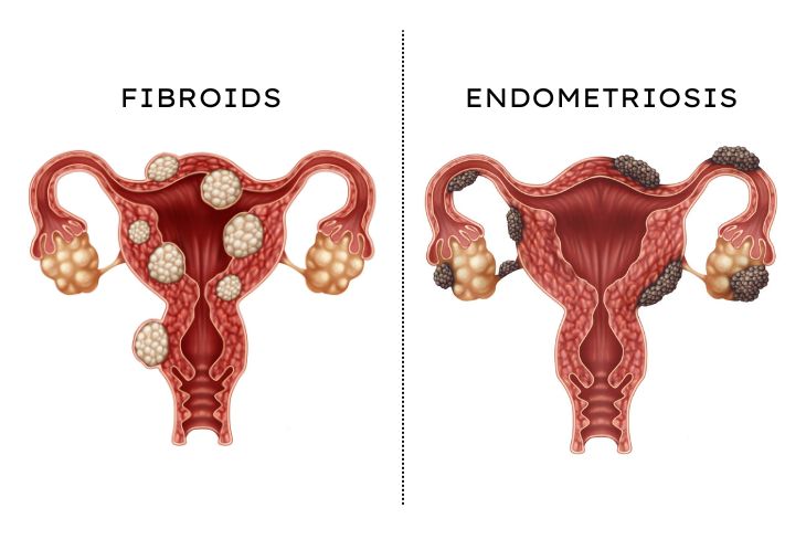 Fibroids and Endometriosis
