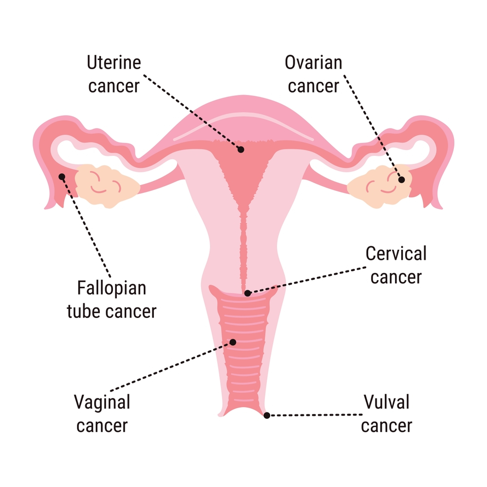 Gyneac Cancer Treatment & Post Cancer surveillance with Dr. Nupura Kashikar